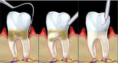 冷光美白牙齿危害亲身经历,牙齿美白科普篇