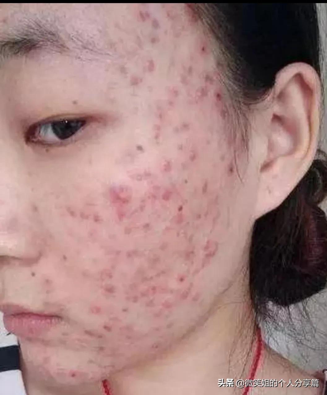 人中反复长痘，长闭口是怎么回事？