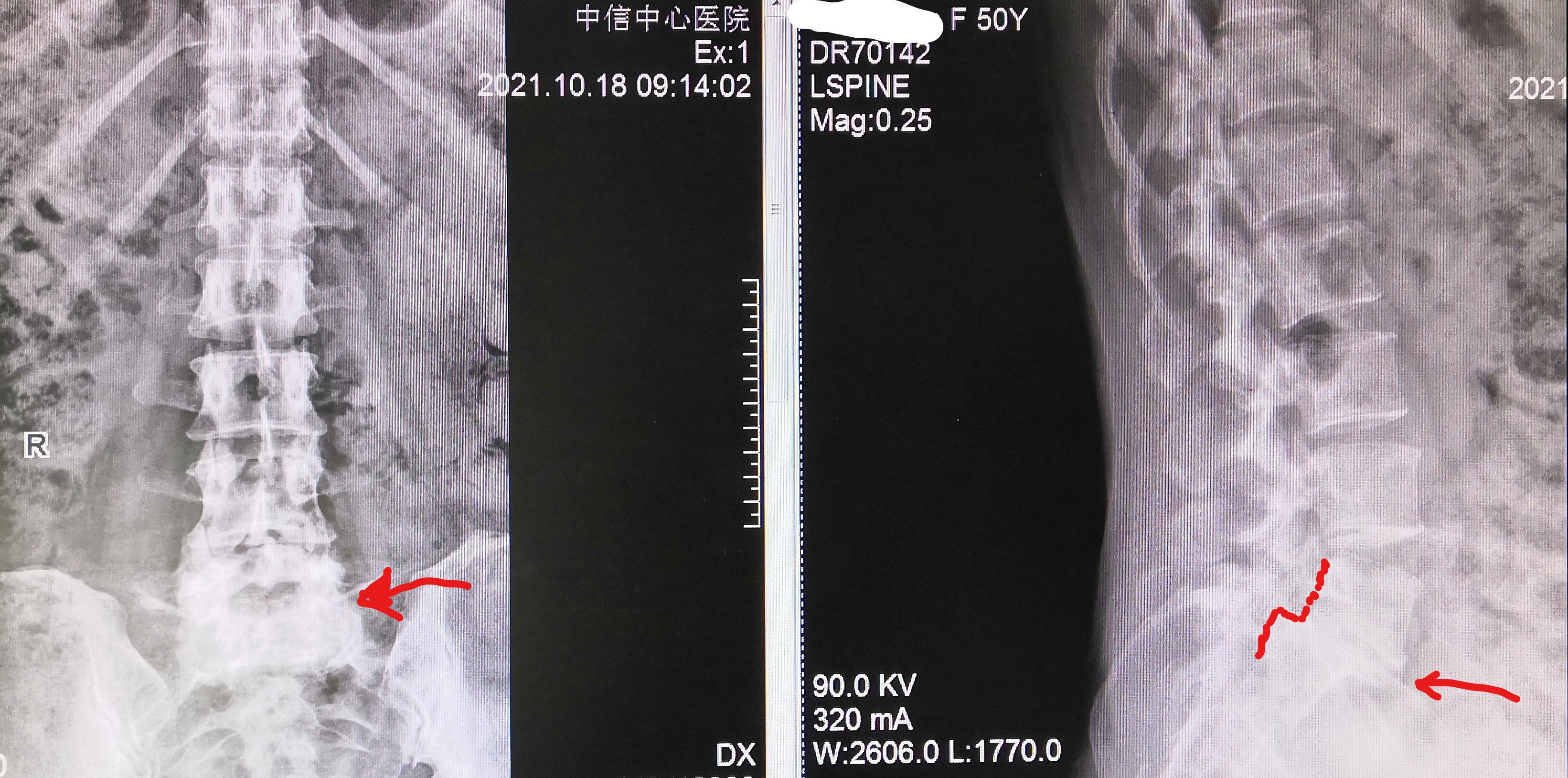 腰椎真性滑脱，手术复位融合固定
