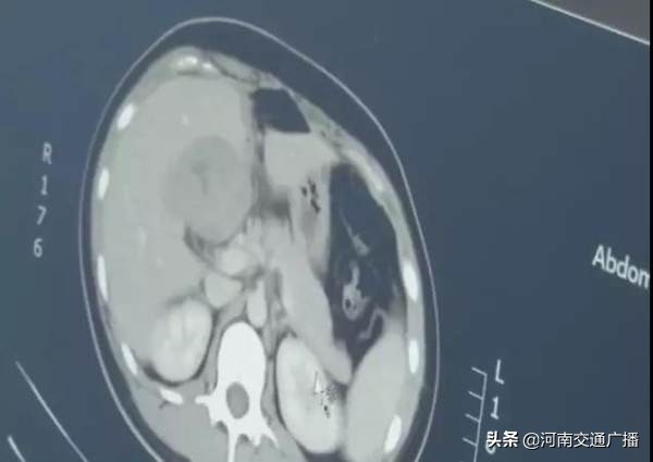 女子怀孕却发现肚子里是20斤肿瘤,怀孕女子肚子里全是蛇卵