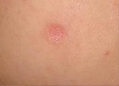 痣真的有那么大的癌变几率吗,痣会癌变真的很可怕吗