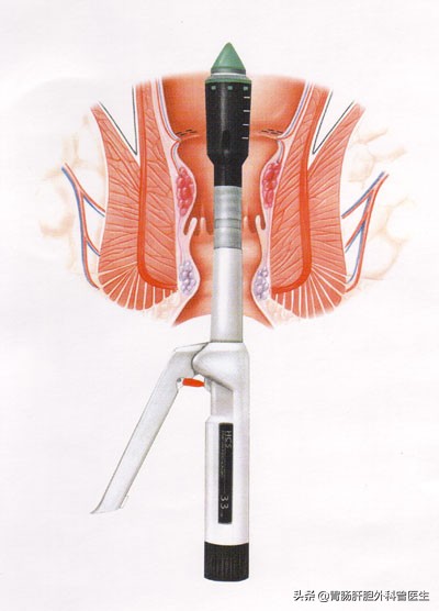 痔疮手术吻合器环切有哪些弊端,痔疮传统手术和吻合器手术哪个好