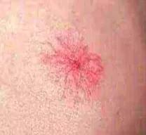 出现痣警惕肝脏病变,肝痣是肝脏发出的求救信号