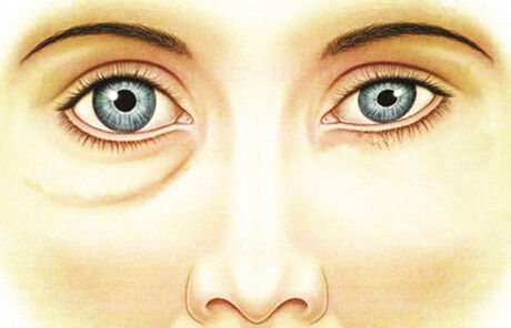 眼袋过大是什么原因怎么办,请问眼袋大是什么引起的怎么治疗