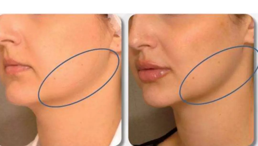 皱纹老化下垂怎么办,眼皮松弛下垂皱纹多最好解决方法