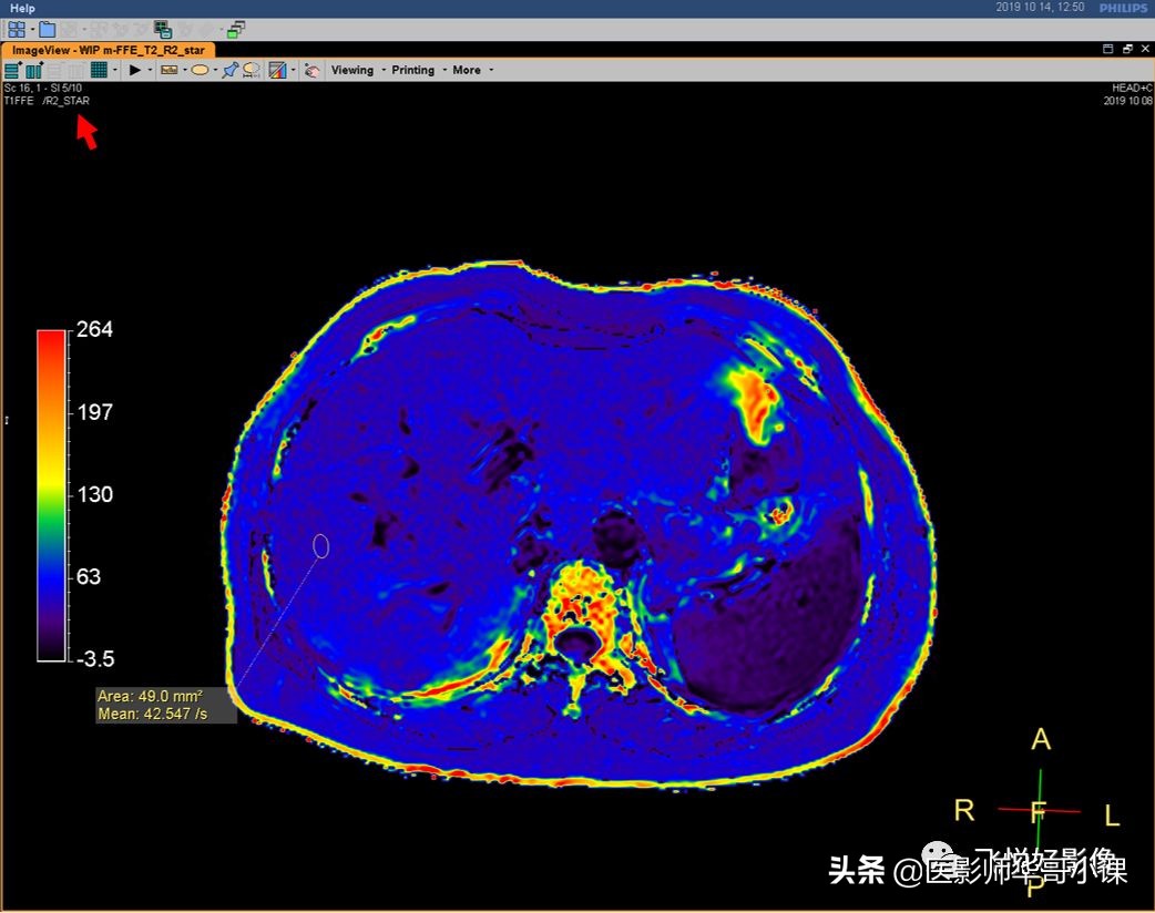飞利浦磁共振快速扫描方案指南,飞利浦1.5t磁共振各部位扫描技术