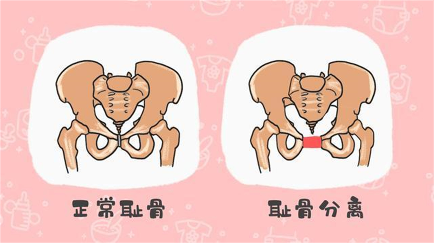 孕晚期耻骨疼患者的注意事项,孕期耻骨疼有什么方法能缓解