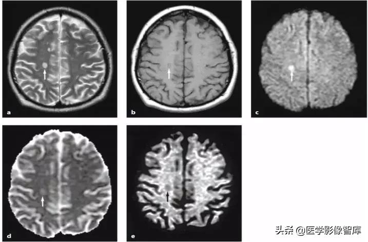 双侧额叶皮层区dwi偏高是什么意思,颅内dwi高信号病变