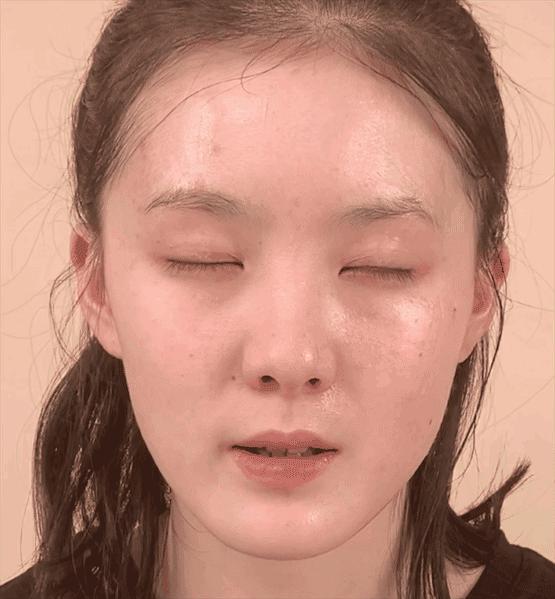 微整的真实效果,微整蜕变过程