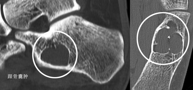 早起下床脚跟痛,早起下床脚踩地脚掌刺痛