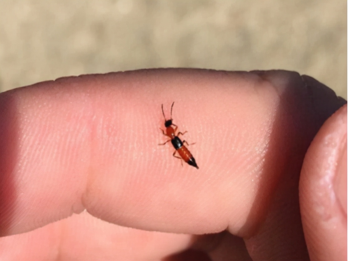 被隐翅虫咬伤有多可怕,被隐翅虫咬后症状图片及治疗方法