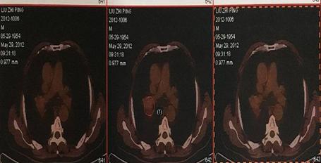局部放疗能彻底治好吗,放射治疗全过程两大阶段