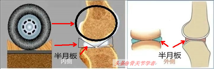 膝关节磁共振如何识别半月板损伤,磁共振半月板越来越严重怎么回事