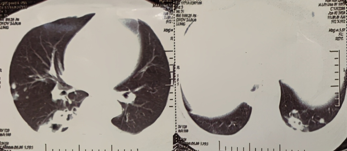木雕老人突然咳嗽、咯血，肺上长了个大窟窿！这种真菌就潜藏在我们身边