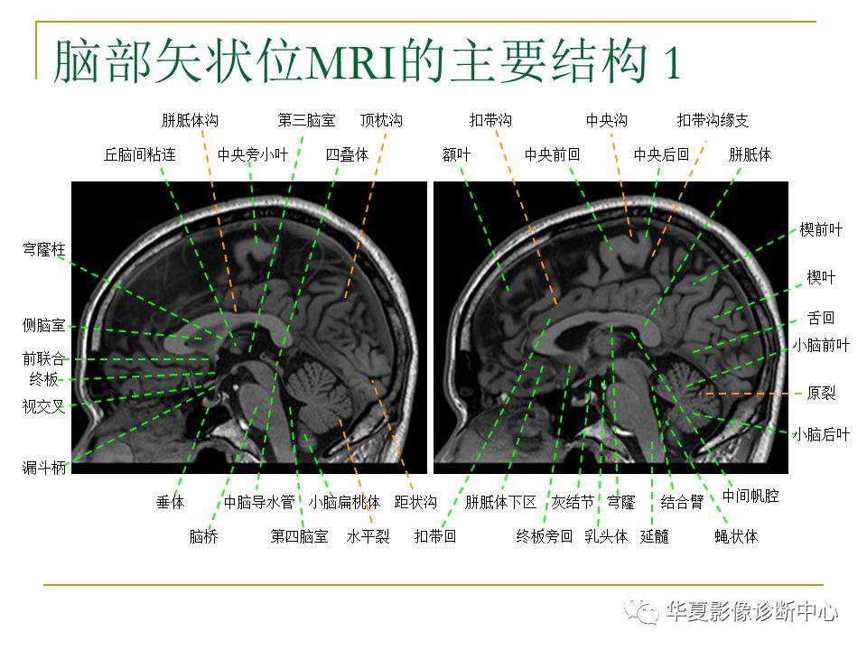 中国人脑立体定向mri应用解剖图谱,脑mri示意图