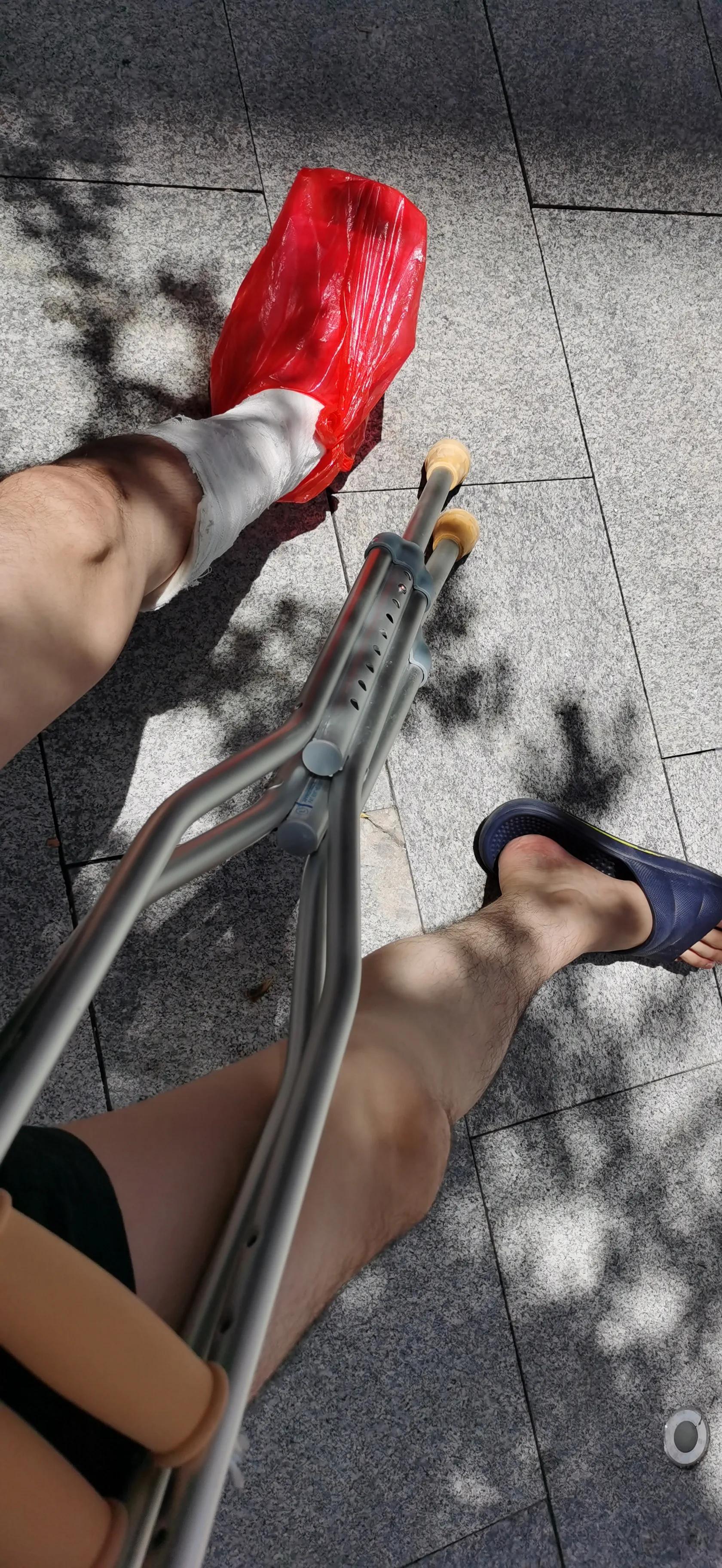 第五跖骨粉碎性骨折多久后能走路,第五跖骨基底骨折100天了走路肿