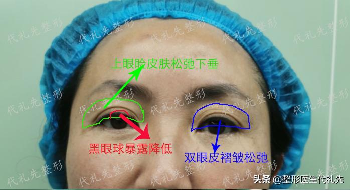 筋膜提眉术后遗症有多严重,提眉手术固定筋膜有后遗症吗