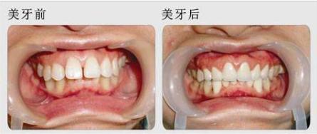 牙齿松动牙缝变宽最佳补救方法,牙齿松动牙缝越来越大是什么原因