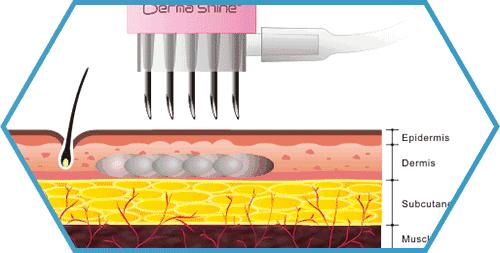 打完玻尿酸和瘦脸针的注意事项,打完玻尿酸和瘦脸针应该注意什么