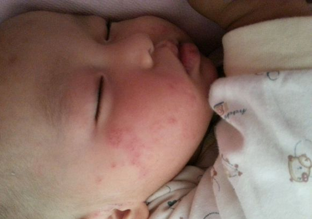 宝宝湿疹破皮可以用修复霜修复吗,宝宝湿疹破皮了是快好了吗