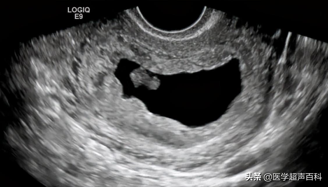 超声提示：胚胎停止发育的诊断、诱因及预防，这些知识你了解多少