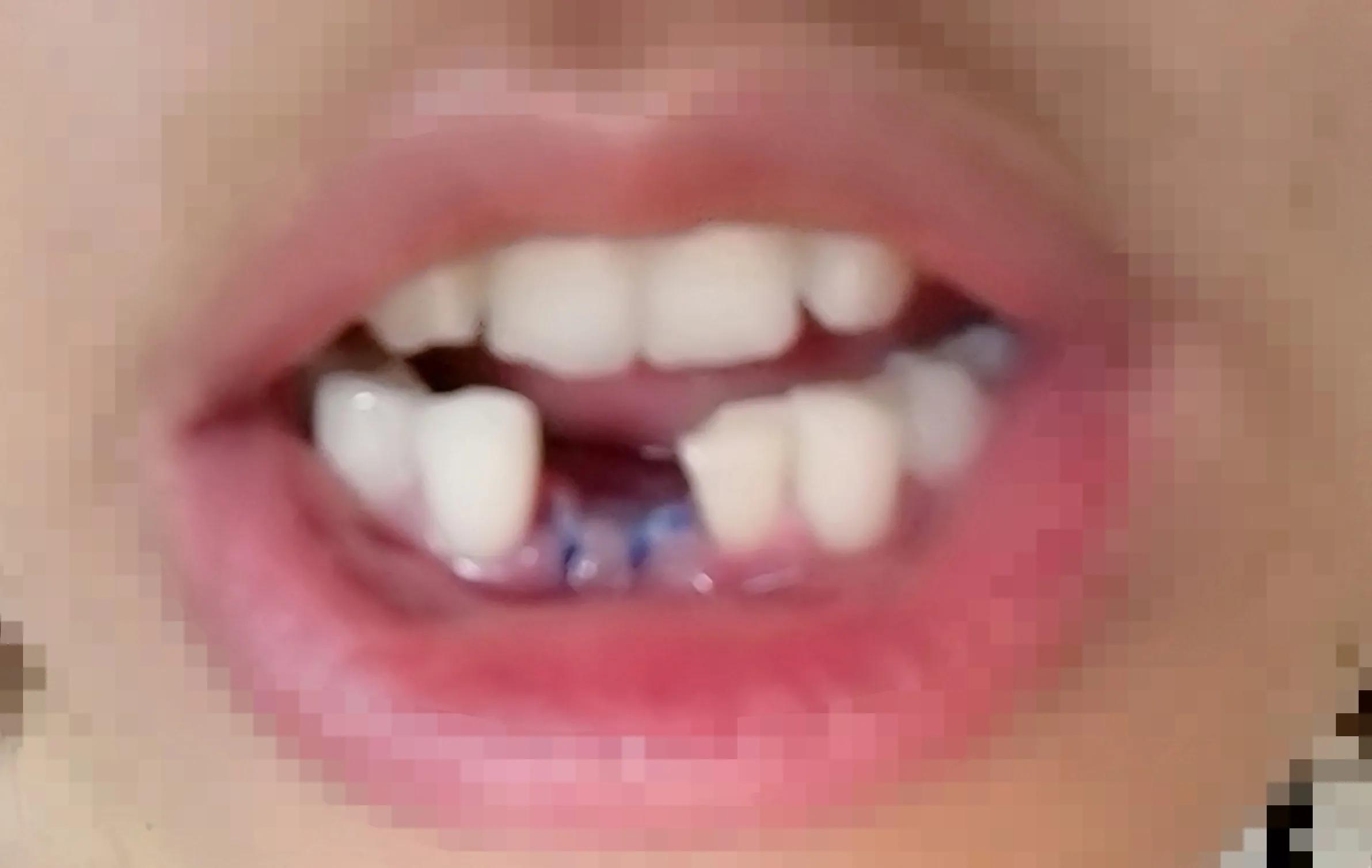 我的种植牙亲身经历,我的种牙经历感受