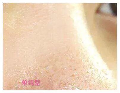 激光缩小毛孔一个疗程多少钱,脸部毛孔缩小做哪个皮肤项目