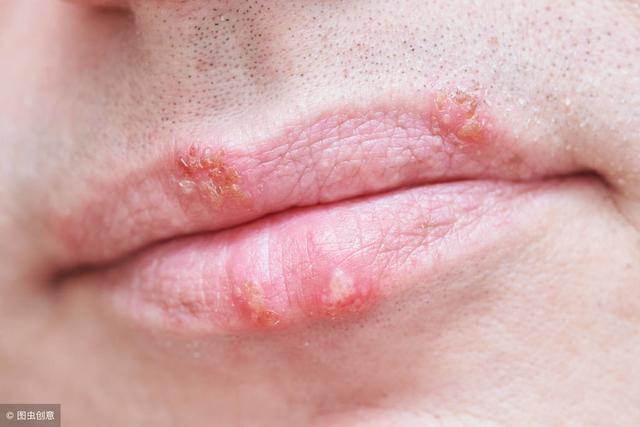 口腔疱疹病毒怎样引起的,备孕期间口腔有疱疹吃什么药