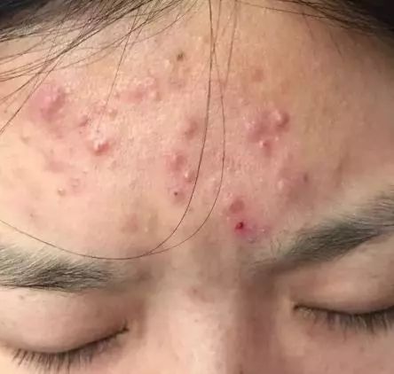 脂肪粒的形成是因为缺少维生素嘛,眼周围的脂肪粒的形成原因是什么