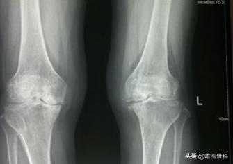 骨刺和骨性关节炎哪个更严重,骨刺也是骨性关节炎吗