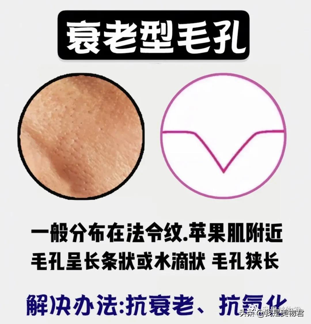 脸上毛孔粗大是什么原因引起的,脸上红血丝毛孔粗大是什么原因