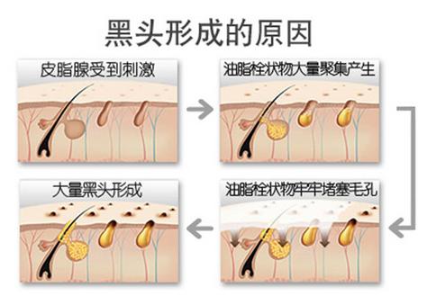 怎么改善毛孔粗大小痘痘,毛孔粗大痘痘改善方法