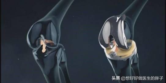 膝盖有骨刺自我疗法,膝盖有骨刺的物理治疗