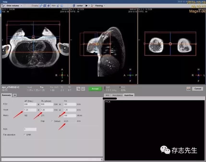 乳腺磁共振亲身经历,磁共振乳腺动态增强扫描全过程