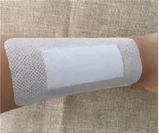 术后拆线时间口诀,粉瘤术后几天拆线