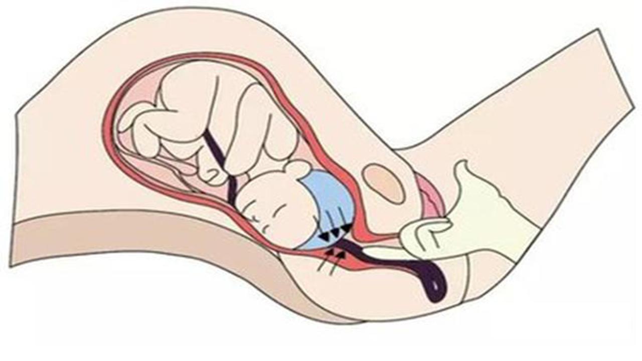 孕妈突然脐带脱垂，胎儿险些缺氧而亡，医生：孕妇平时要注意这4点