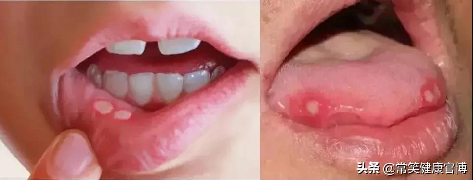 上火喉咙痛口腔溃疡眼睛痛,上火牙龈出血口腔溃疡