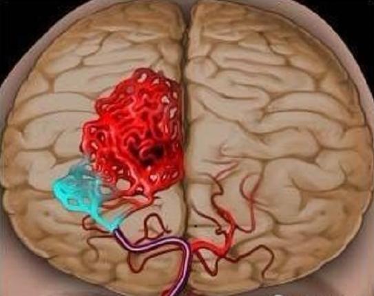睡觉时手发麻是什么病的前兆,手发麻发痒是什么病的前兆