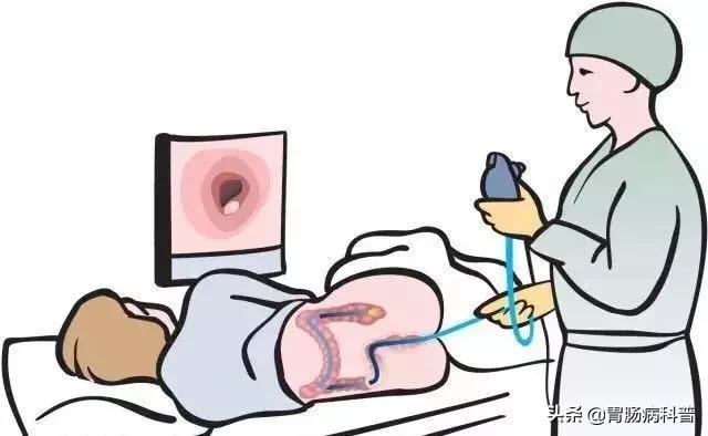 肠镜检查从肛门开始检查吗,电子肠镜检查前注意事项