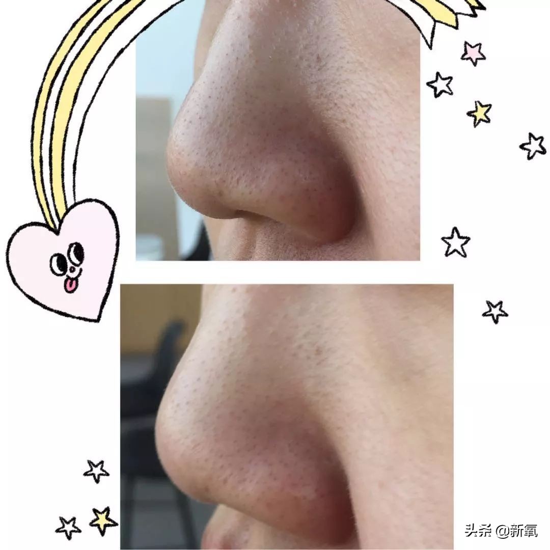 亲测非常有效的去黑头方法,去黑头最有效的方法三天见效