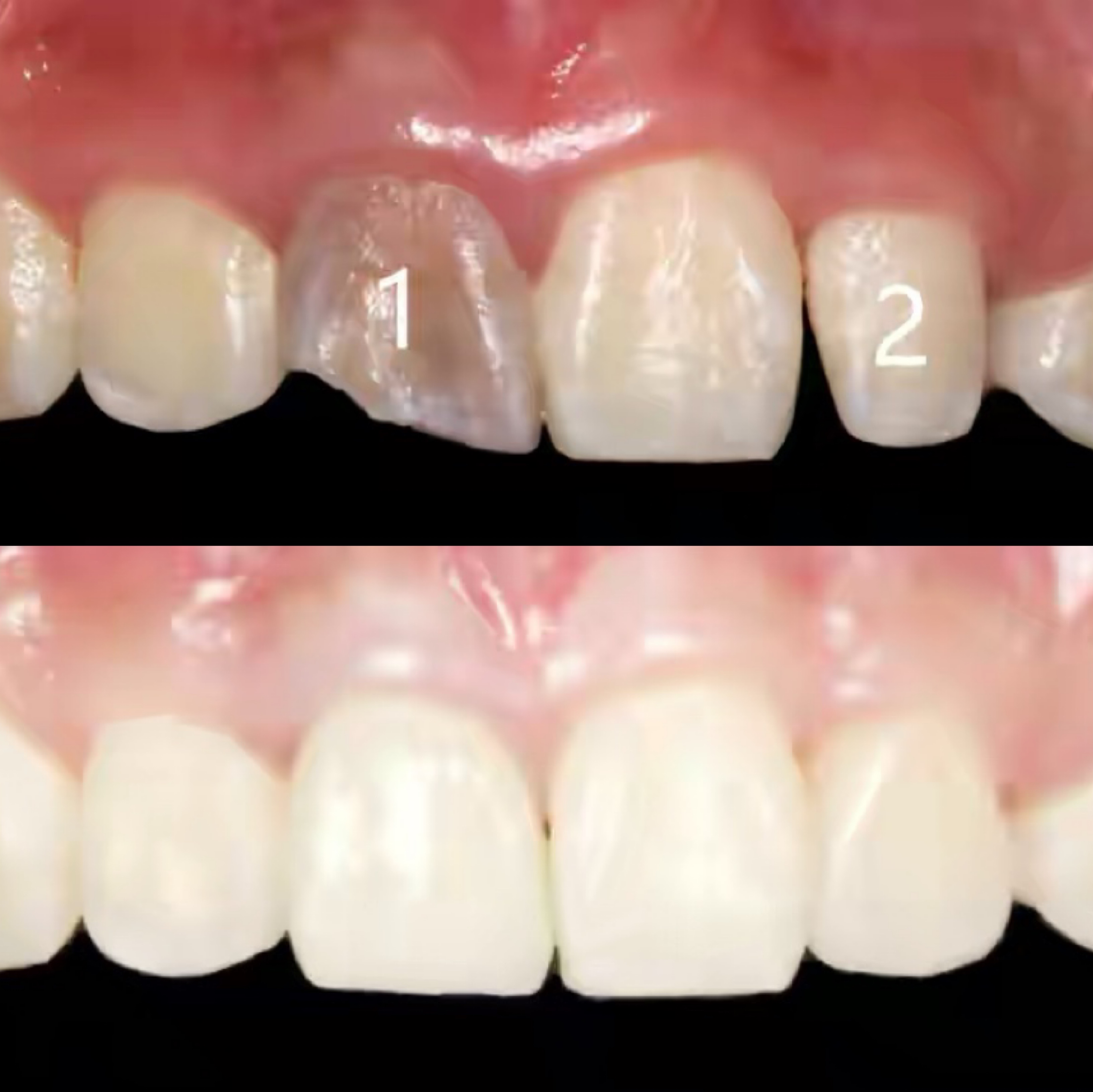 牙齿美白有这几种方法你了解多少,牙齿美白靠谱吗十年牙医告诉你