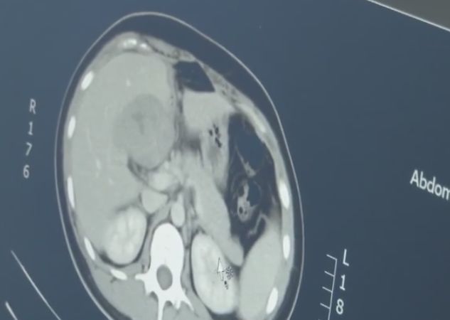 女子怀孕肚子里却空空如也,女子怀孕胎儿竟在肝脏中