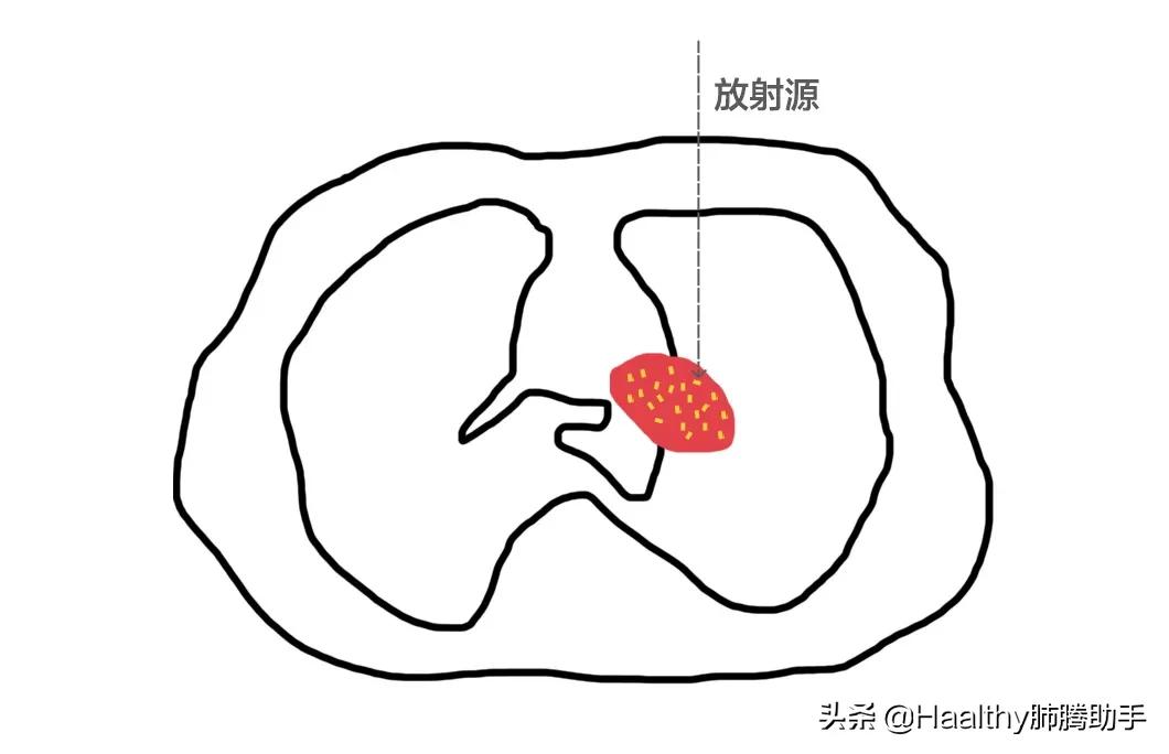 带着射线逛街，很拉风吧|肺腾讲堂：内放疗与外放疗的区别