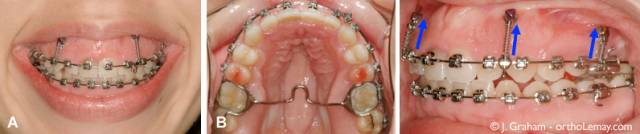 笑露牙龈怎么整,笑露牙龈怎么矫正训练