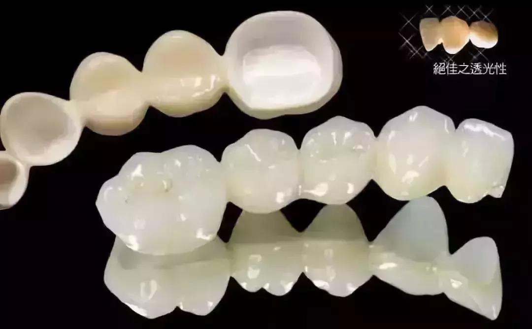 全瓷牙与烤瓷牙价格差多少,全瓷牙和烤瓷牙的价格差多少