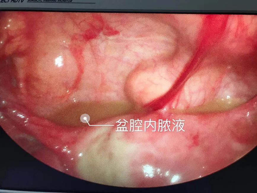 急性盆腔脓肿早期最佳治疗,盆腔脓肿的手术指征