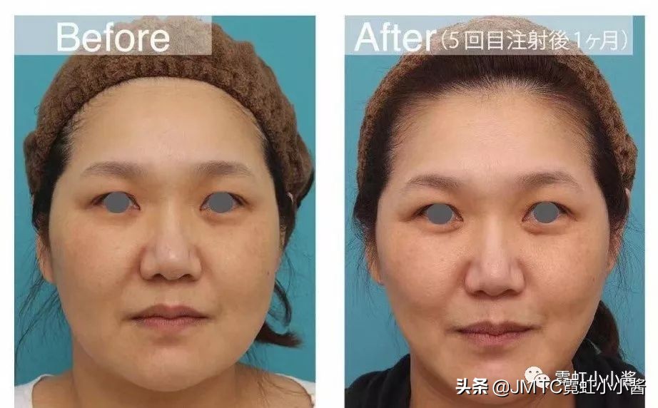 记录翻译小姐姐日本打溶脂针，肉脸变骨感脸全过程｜日本医美
