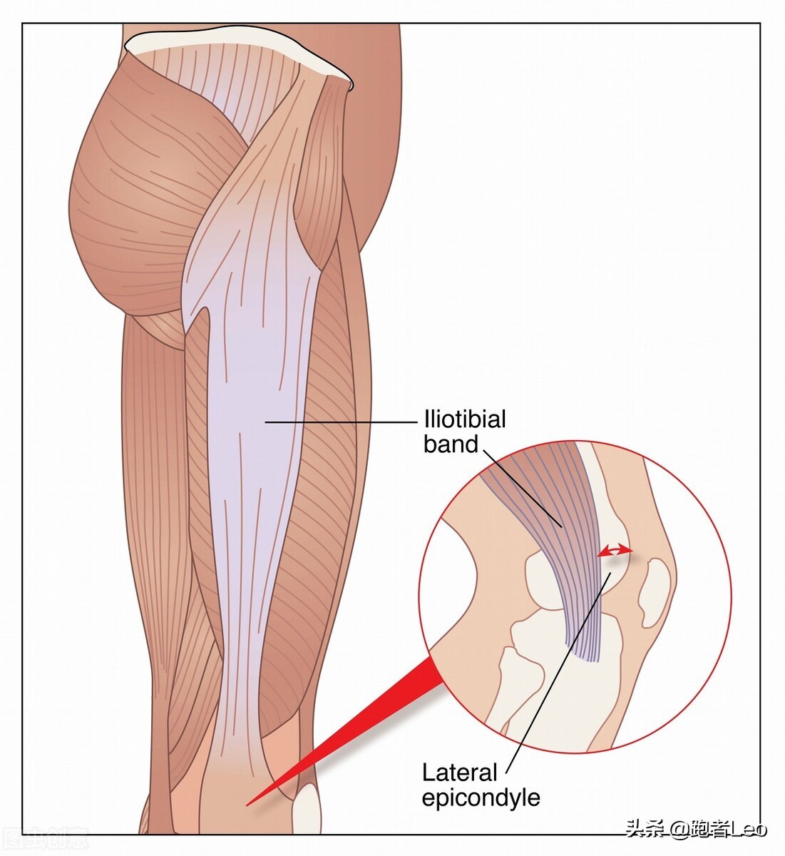 有被髂胫束综合症困扰的吗,髂胫束综合征如何快速好起来