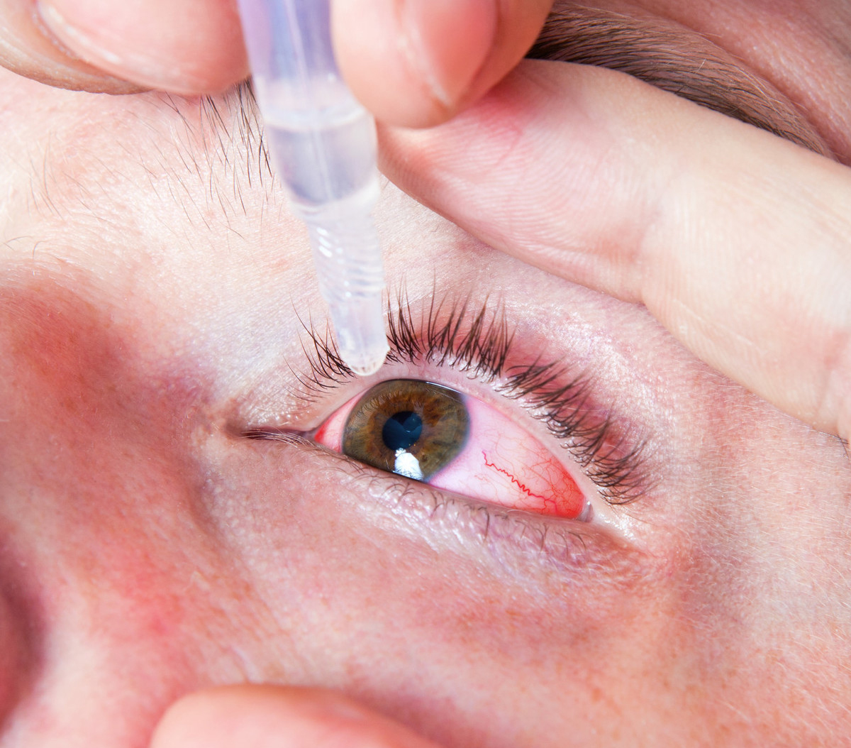 一到这个季节眼睛就发痒怎么治呢,眼睛一到春秋季节就奇痒无比