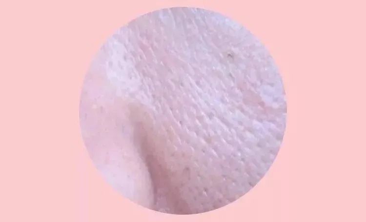 毛孔粗大最全攻略解决办法,毛孔粗大别担心记住这招全搞定